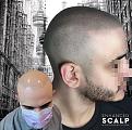 Click image for larger version

Name:	Scalp Micropigmentation Toronto Touch up.jpg
Views:	152
Size:	94.6 KB
ID:	445301
