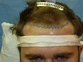 Click image for larger version

Name:	pre-op hairline drawn in.jpg
Views:	368
Size:	87.4 KB
ID:	451123