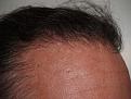 Click image for larger version

Name:	After Hairline.jpg
Views:	388
Size:	95.4 KB
ID:	452447