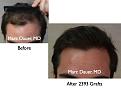 Click image for larger version

Name:	Hair Transplant Slides.007.jpg
Views:	409
Size:	58.7 KB
ID:	462820