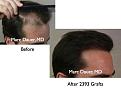 Click image for larger version

Name:	Hair Transplant Slides.008.jpg
Views:	423
Size:	57.3 KB
ID:	462821
