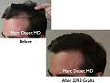 Click image for larger version

Name:	Hair Transplant Slides.009.jpg
Views:	367
Size:	54.6 KB
ID:	462822