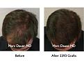 Click image for larger version

Name:	Hair Transplant Slides.010.jpg
Views:	395
Size:	70.6 KB
ID:	462823