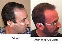 Click image for larger version

Name:	Hair Transplant Slides3.200.jpg
Views:	630
Size:	83.7 KB
ID:	467679