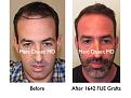 Click image for larger version

Name:	Hair Transplant Slides3.199.jpg
Views:	649
Size:	79.5 KB
ID:	467680