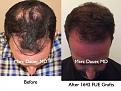 Click image for larger version

Name:	Hair Transplant Slides3.202.jpg
Views:	421
Size:	89.8 KB
ID:	467681