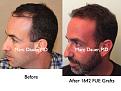 Click image for larger version

Name:	Hair Transplant Slides3.201.jpg
Views:	539
Size:	80.1 KB
ID:	467682