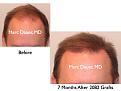 Click image for larger version

Name:	Hair Transplant Slides.263.jpg
Views:	309
Size:	57.3 KB
ID:	469309