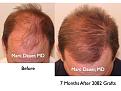 Click image for larger version

Name:	Hair Transplant Slides.266.jpg
Views:	316
Size:	79.0 KB
ID:	469310