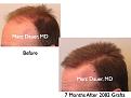 Click image for larger version

Name:	Hair Transplant Slides.264.jpg
Views:	309
Size:	58.4 KB
ID:	469311