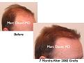 Click image for larger version

Name:	Hair Transplant Slides.265.jpg
Views:	303
Size:	58.5 KB
ID:	469312