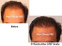 Click image for larger version

Name:	Hair Transplant Slides1.282.jpg
Views:	242
Size:	65.1 KB
ID:	469359