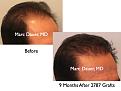 Click image for larger version

Name:	Hair Transplant Slides1.284.jpg
Views:	204
Size:	60.5 KB
ID:	469360