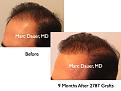 Click image for larger version

Name:	Hair Transplant Slides1.283.jpg
Views:	218
Size:	59.5 KB
ID:	469361