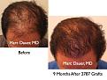 Click image for larger version

Name:	Hair Transplant Slides1.285.jpg
Views:	223
Size:	76.9 KB
ID:	469362