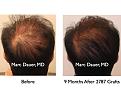 Click image for larger version

Name:	Hair Transplant Slides1.286.jpg
Views:	215
Size:	66.0 KB
ID:	469363