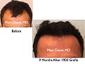 Click image for larger version

Name:	Hair Transplant Slides5.322.jpg
Views:	276
Size:	61.7 KB
ID:	469703
