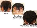 Click image for larger version

Name:	Hair Transplant Slides5.323.jpg
Views:	312
Size:	70.8 KB
ID:	469704