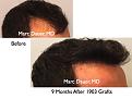 Click image for larger version

Name:	Hair Transplant Slides5.325.jpg
Views:	277
Size:	67.6 KB
ID:	469705