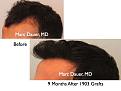 Click image for larger version

Name:	Hair Transplant Slides5.324.jpg
Views:	257
Size:	62.1 KB
ID:	469706