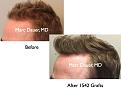 Click image for larger version

Name:	Hair Transplant Slides5.382.jpg
Views:	311
Size:	63.5 KB
ID:	470047