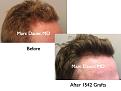 Click image for larger version

Name:	Hair Transplant Slides5.383.jpg
Views:	420
Size:	63.0 KB
ID:	470048