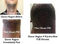Click image for larger version

Name:	Hair Transplant Slides.423.jpg
Views:	712
Size:	81.3 KB
ID:	470235