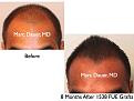 Click image for larger version

Name:	Hair Transplant Slides.515.jpg
Views:	279
Size:	33.1 KB
ID:	470836