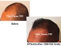 Click image for larger version

Name:	Hair Transplant Slides.516.jpg
Views:	251
Size:	32.5 KB
ID:	470837