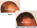 Click image for larger version

Name:	Hair Transplant Slides.517.jpg
Views:	273
Size:	35.1 KB
ID:	470838
