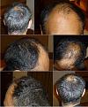 Click image for larger version

Name:	1. Day Before FUE.jpg
Views:	1068
Size:	96.1 KB
ID:	471678