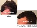 Click image for larger version

Name:	Hair Transplant Slides.660.jpg
Views:	290
Size:	61.1 KB
ID:	473649