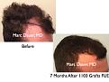 Click image for larger version

Name:	Hair Transplant Slides.661.jpg
Views:	306
Size:	65.8 KB
ID:	473650