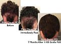 Click image for larger version

Name:	Hair Transplant Slides.662.jpg
Views:	288
Size:	81.2 KB
ID:	473651