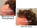 Click image for larger version

Name:	Hair Transplant Slides.717.jpg
Views:	278
Size:	77.2 KB
ID:	474071