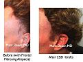 Click image for larger version

Name:	Hair Transplant Slides.720.jpg
Views:	617
Size:	92.0 KB
ID:	474074