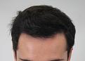 Click image for larger version

Name:	hair transplant 7 mos post 4.jpg
Views:	899
Size:	82.2 KB
ID:	474826