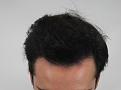 Click image for larger version

Name:	hair transplant 7 mos post 5.jpg
Views:	758
Size:	85.7 KB
ID:	474827