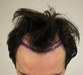 Click image for larger version

Name:	hair transplant before 5.jpg
Views:	1294
Size:	75.2 KB
ID:	474828