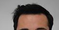 Click image for larger version

Name:	hair transplant 7 mos post 1.jpg
Views:	811
Size:	85.9 KB
ID:	474836
