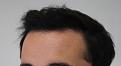 Click image for larger version

Name:	hair transplant 7 mos post 2.jpg
Views:	799
Size:	77.5 KB
ID:	474837