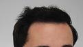 Click image for larger version

Name:	hair transplant 7 mos post 3.jpg
Views:	806
Size:	83.1 KB
ID:	474838