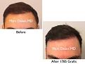 Click image for larger version

Name:	Hair Transplant Slides copy5.001.jpg
Views:	229
Size:	10.9 KB
ID:	475097