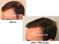 Click image for larger version

Name:	Hair Transplant Slides copy5.002.jpg
Views:	223
Size:	12.0 KB
ID:	475099