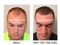Click image for larger version

Name:	Hair Transplant Slides copy12.001.jpg
Views:	277
Size:	14.2 KB
ID:	475334