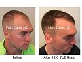 Click image for larger version

Name:	Hair Transplant Slides copy12.003.jpg
Views:	258
Size:	14.4 KB
ID:	475336
