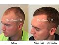Click image for larger version

Name:	Hair Transplant Slides copy12.004.jpg
Views:	264
Size:	14.6 KB
ID:	475337