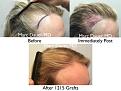 Click image for larger version

Name:	Hair Transplant Slides copy15.004.jpg
Views:	238
Size:	17.1 KB
ID:	475521