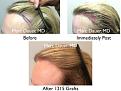 Click image for larger version

Name:	Hair Transplant Slides copy15.005.jpg
Views:	225
Size:	17.0 KB
ID:	475522