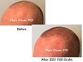 Click image for larger version

Name:	Hair Transplant Slides copy17.002.jpg
Views:	918
Size:	11.6 KB
ID:	475583
